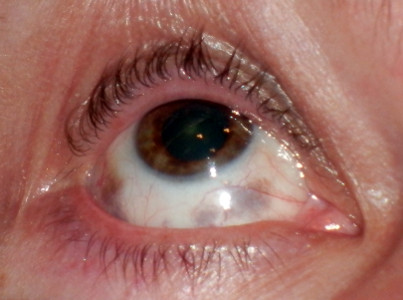Melanoza oczna zmiany barwnikowe spojówek